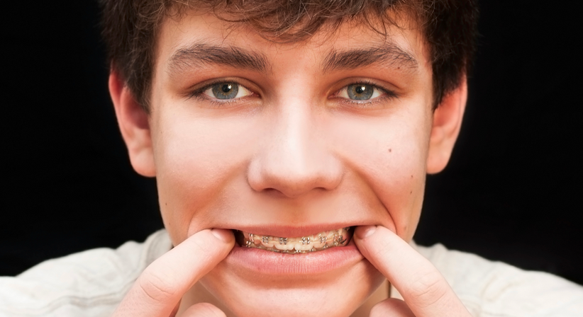 Festsitzende Zahnspange - Dr. Fanny Triessnig - Zahnärztin Wien 1010