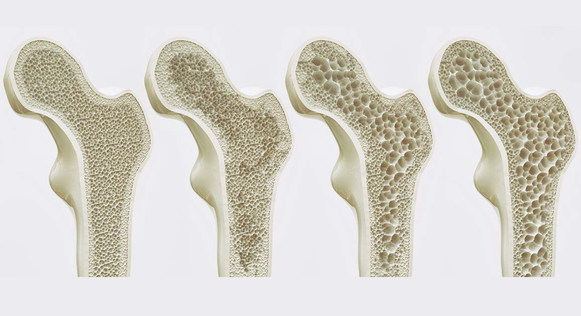 Osteoporose (Knochenschwund) - Dr. Manuel Becede - Rheumatologe Tulln an der Donau 3430