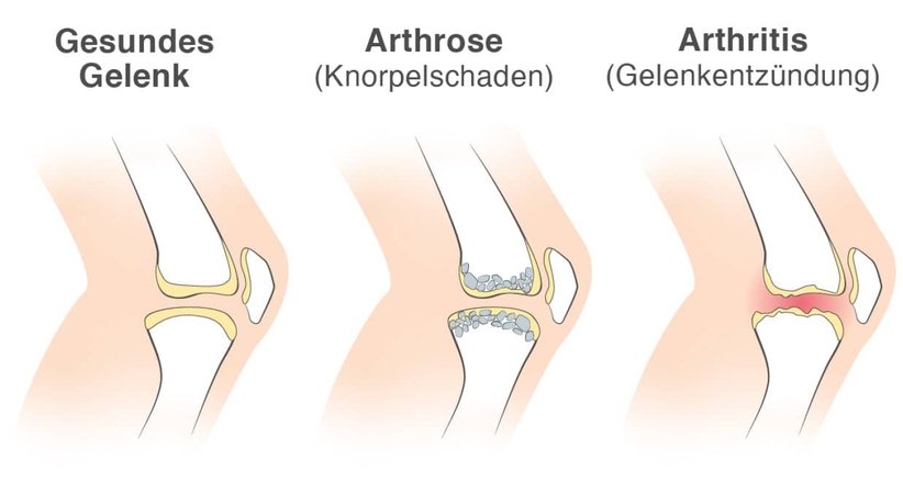 Arthritis / Chronisch-entzündliche Gelenkerkrankungen - Dr. Manuel Becede - Rheumatologe Tulln an der Donau 3430