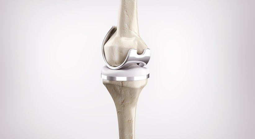 Knieprothese / Teilprothese und Total-Endoprothese (Knie-TEP) - OA Dr. Christopher Godwin-Toby - Orthopäde Traiskirchen 2514