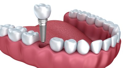 3D computernavigierte Implantologie