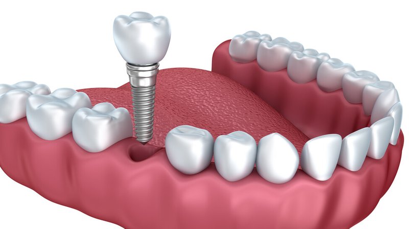 3D computernavigierte Implantologie - Dr. Robert Stillmann, MSc - Zahnarzt Wien 1190