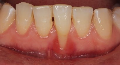 Individuelle Parodontitistherapie