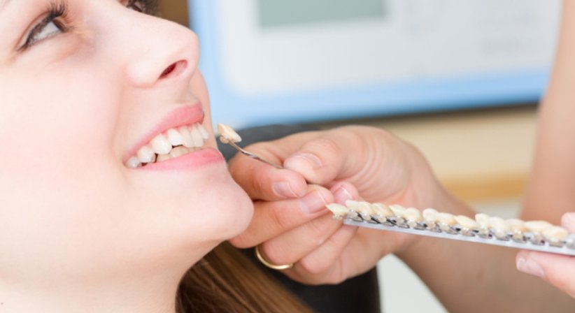 Veneers - Dr. Eva Kovacs-Rezban - Zahnärztin Wien 1070