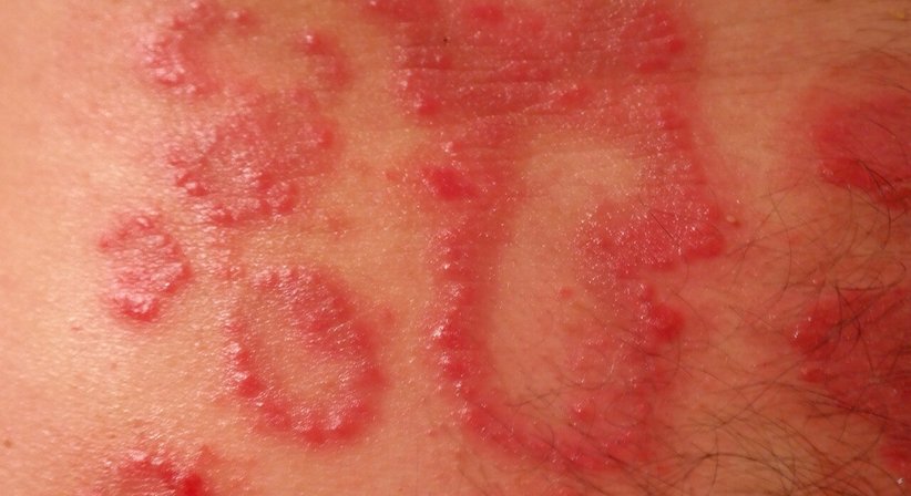 Dermatologische Behandlung - Dr. med. univ. Hanaa Hasan, FEBDV - Hautärztin Wien 1050