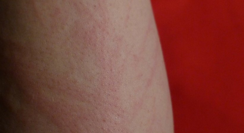 Dermatologische Behandlung - Dr. med. univ. Hanaa Hasan, FEBDV - Hautärztin Wien 1050