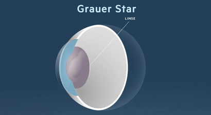 Grauer Star (Katarakt) 