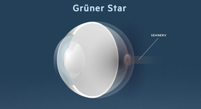 Grüner Star (Glaukom) 