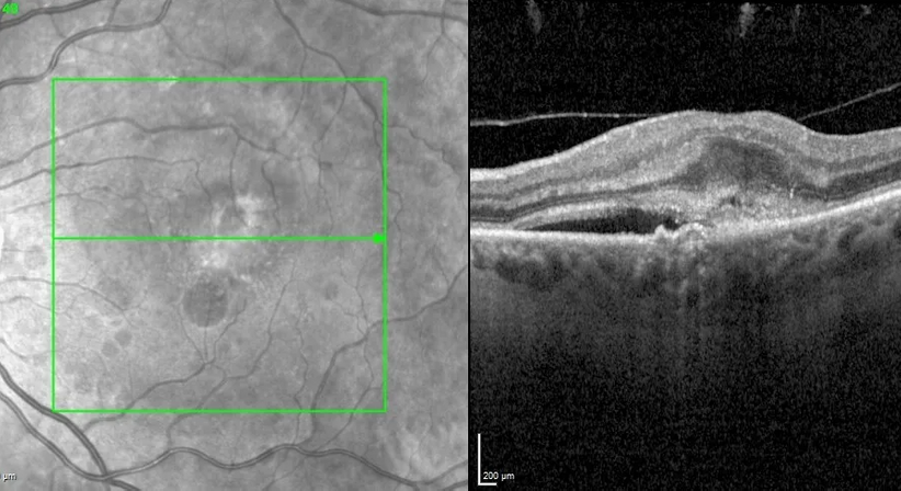 Makula-Erkrankungen - Prof. Dr. Dr.  Nikolaus Luft, FEBO, FWCRS - Augenarzt Wien 1010