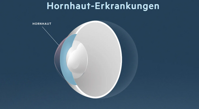Hornhaut-Erkrankungen