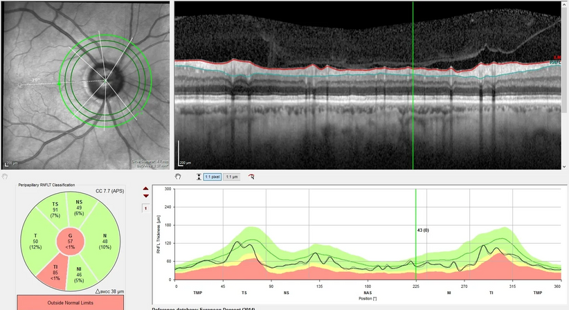 Grüner Star (Glaukom)  - Prof. Dr. Dr.  Nikolaus Luft, FEBO, FWCRS - Augenarzt Wien 1010