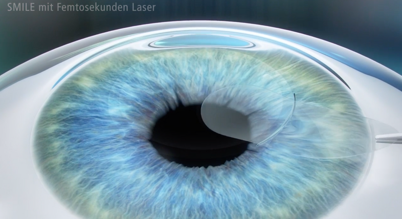 Relex SMILE - Prof. Dr. Dr.  Nikolaus Luft, FEBO, FWCRS - Augenarzt Wien 1010