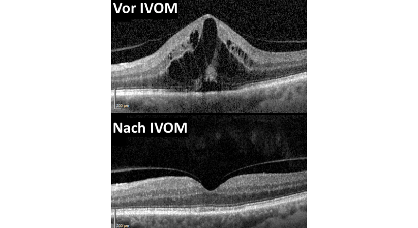 IVOM (Intravitreale Medikamenteneingabe) - Prof. Dr. Dr.  Nikolaus Luft, FEBO, FWCRS - Augenarzt Wien 1010