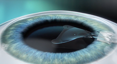 ICL – Implantierbare Collamer Linse