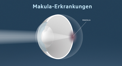 Makula-Erkrankungen