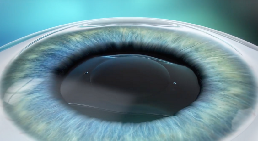 ICL – Implantierbare Collamer Linse - Prof. Dr. Dr.  Nikolaus Luft, FEBO, FWCRS - Augenarzt Wien 1010