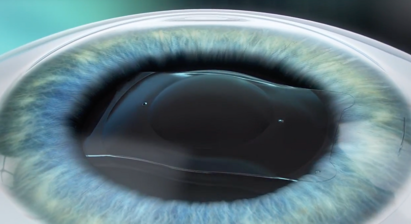 ICL – Implantierbare Collamer Linse - Prof. Dr. Dr.  Nikolaus Luft, FEBO, FWCRS - Augenarzt Wien 1010