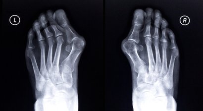 Hallux valgus