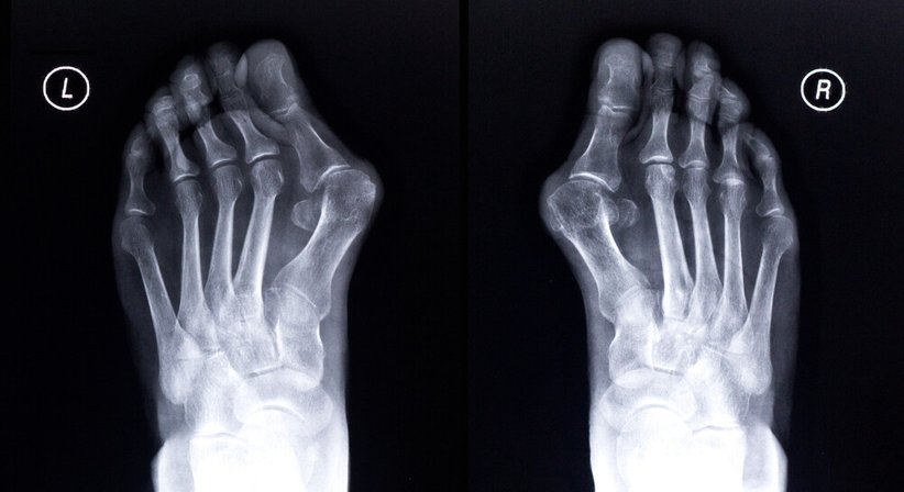 Hallux valgus - Dr. Andreas Gfrerrer, MSc - Orthopäde Stockerau 2000