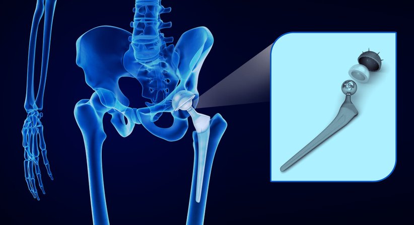 Hüftprothese - Dr. Andreas Gfrerrer, MSc - Orthopäde Stockerau 2000