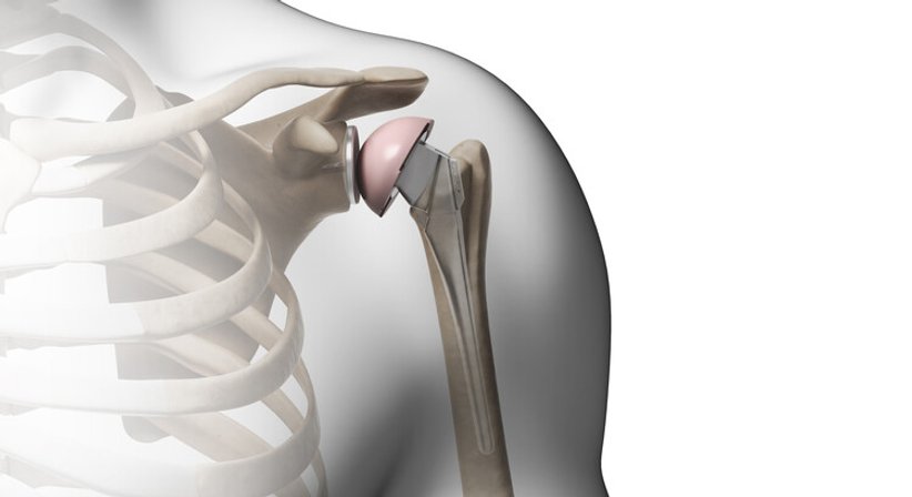 Schulterarthrose, Schulterprothese - Dr. Andreas Gfrerrer, MSc - Orthopäde Stockerau 2000