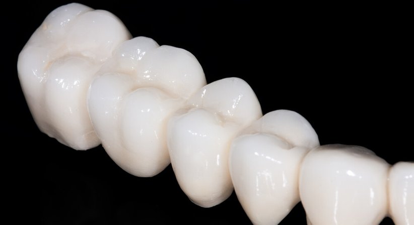 Keramikkronen und -brücken - Dr. med. dent. Timea Wicker - Zahnärztin Wien 1010