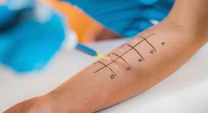 Allergietest und Behandlung