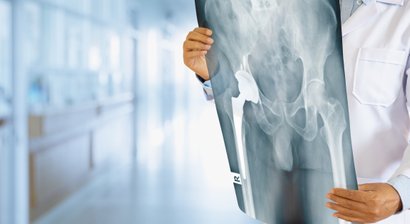 Endoprothetische, minimalinvasive Hüftoperation (Hüft-TEP) zur Behandlung einer schweren Hüftarthrose (Coxarthrose)