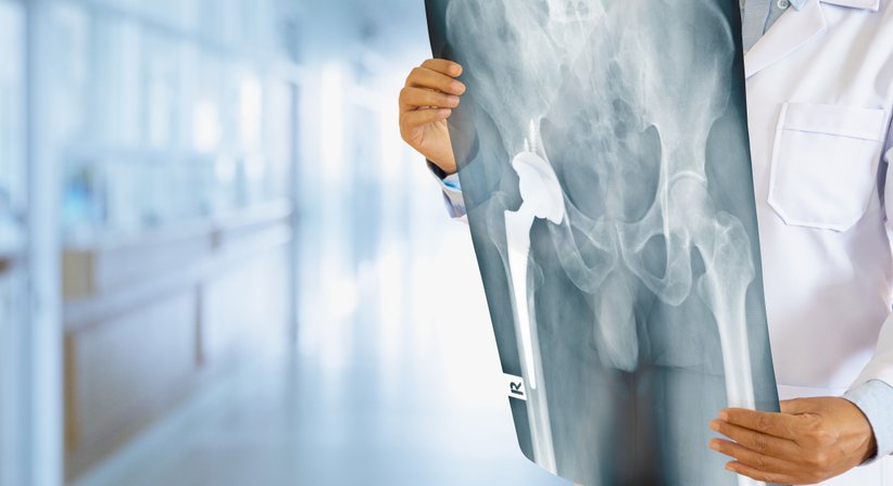 Endoprothetische, minimalinvasive Hüftoperation (Hüft-TEP) zur Behandlung einer schweren Hüftarthrose (Coxarthrose) - Prim.a.D. Priv.-Doz. Dr. med. univ. Roman Radl, MBA - Orthopäde Graz 8010