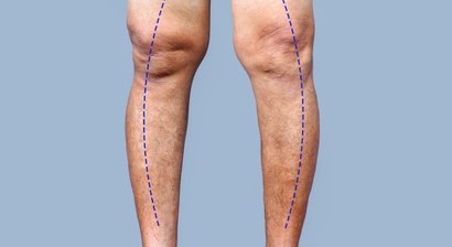 Chirurgische Beinachsenkorrektur (Umstellungsosteotomie)