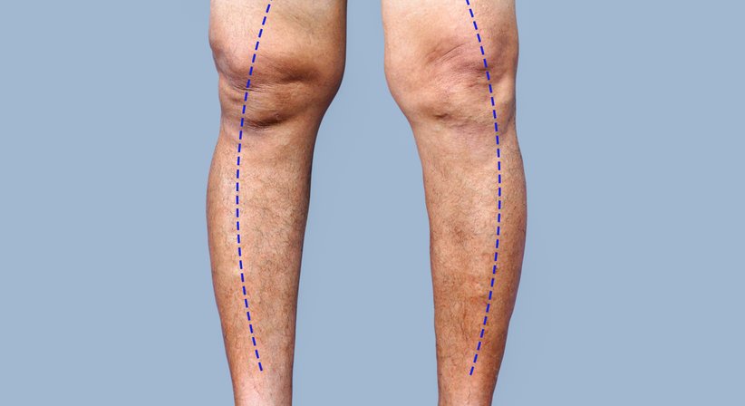 Chirurgische Beinachsenkorrektur (Umstellungsosteotomie) - Prim.a.D. Priv.-Doz. Dr. med. univ. Roman Radl, MBA - Orthopäde Graz 8010
