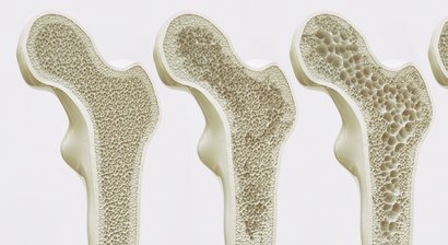 Osteoporose Behandlung
