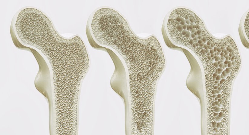 Osteoporose Behandlung - Prim.a.D. Priv.-Doz. Dr. med. univ. Roman Radl, MBA - Orthopäde Graz 8010