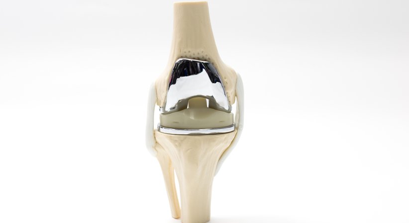 Einsatz eines künstlichen Kniegelenks bei fortgeschrittener Gonarthrose (Kniegelenkarthrose) - Prim.a.D. Priv.-Doz. Dr. med. univ. Roman Radl, MBA - Orthopäde Graz 8010