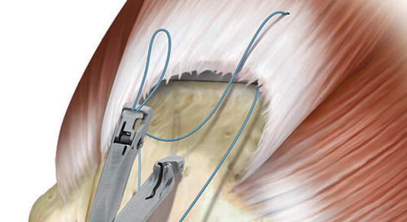 Arthroskopische Sehnennaht - OA Dr. Markus Riedl - Orthopäde Wien 1190