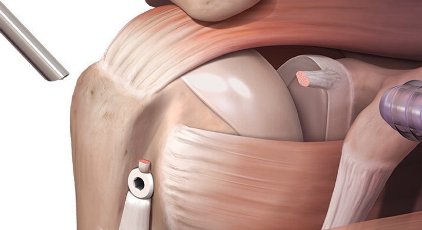 Arthroskopische Behandlung der langen Bizepssehne - OA Dr. Markus Riedl - Orthopäde Wien 1190