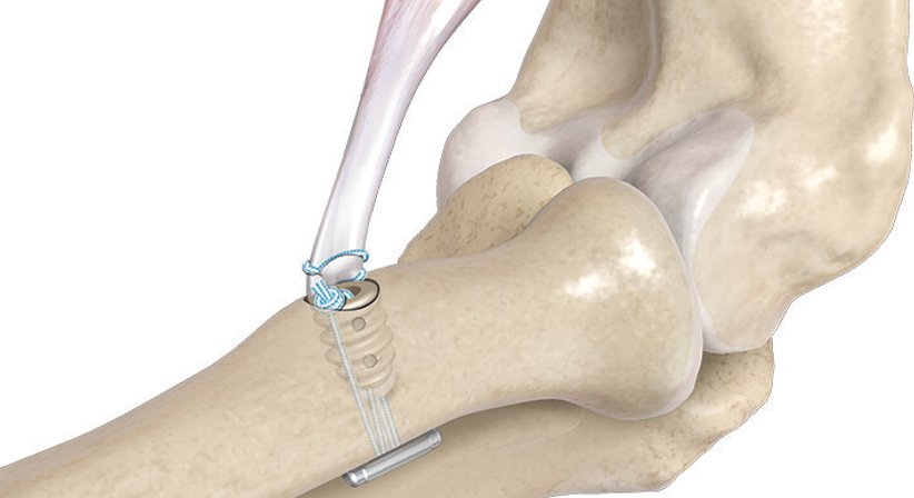 Distale Bizepssehnenruptur - OA Dr. Markus Riedl - Orthopäde Wien 1190