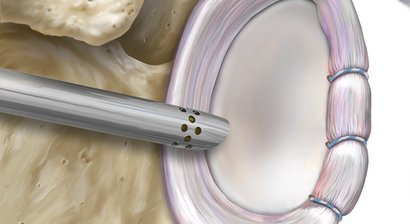 Arthroskopische Schulterstabilisierung