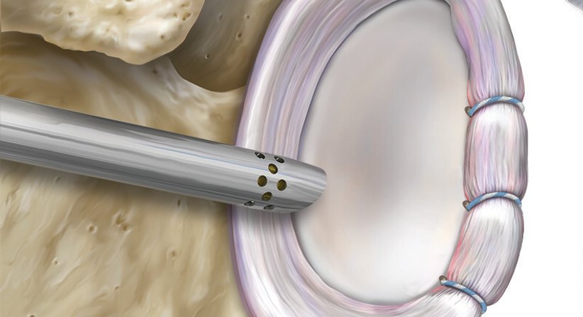 Arthroskopische Schulterstabilisierung - OA Dr. Markus Riedl - Orthopäde Wien 1190