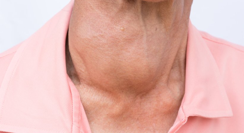 Struma - Assoc. Prof. Priv.-Doz. Dr. Gregor Heiduschka - HNO-Arzt Wien 1190