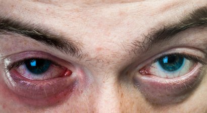  Bindehautentzündung