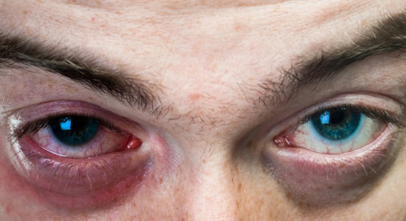  Bindehautentzündung - Priv.-Doz. Dr. Jan Lammer - Augenarzt Wien 1190