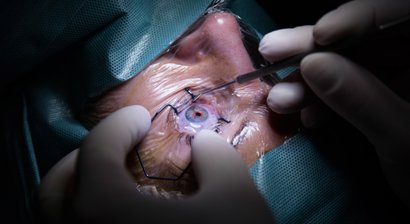 Hornhauttransplantation