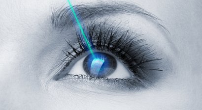 Refraktive Laserkorrekturen von Fehlsichtigkeiten