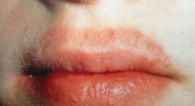 Kinderdermatologie - Dr. Ulrike Wieland - Hautärztin Salzburg 5020
