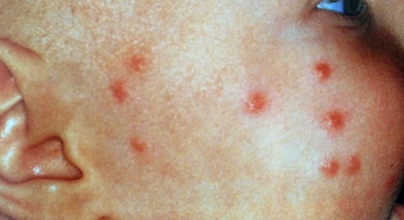 Kinderdermatologie - Dr. Ulrike Wieland - Hautärztin Salzburg 5020