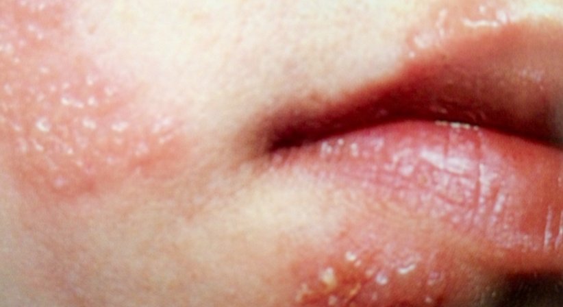 Klassische Dermatologie - Dr. Ulrike Wieland - Hautärztin Salzburg 5020