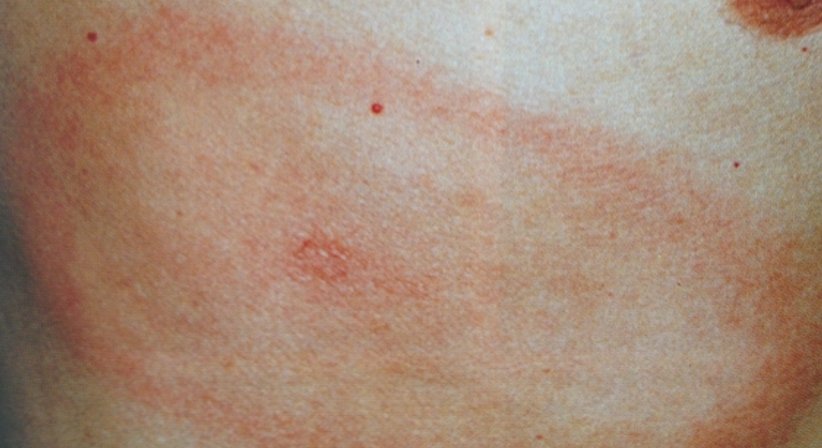 Klassische Dermatologie - Dr. Ulrike Wieland - Hautärztin Salzburg 5020