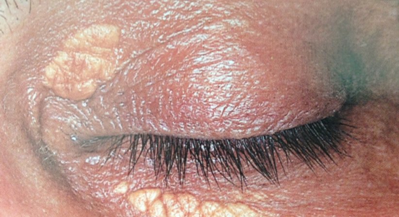 Laserbehandlung - Dr. Ulrike Wieland - Hautärztin Salzburg 5020