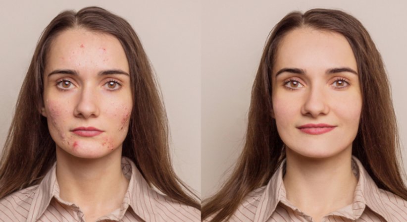 Narbenbehandlung - Dr. Ulrike Wieland - Hautärztin Salzburg 5020